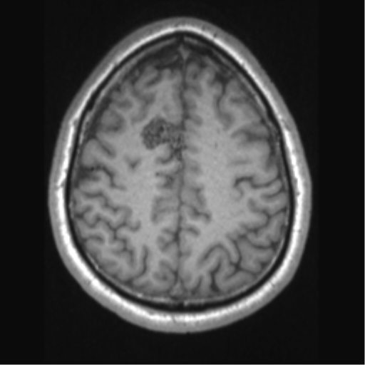 Cerebral arteriovenous malformation (Radiopaedia 39259-41506 Axial T1 58).png