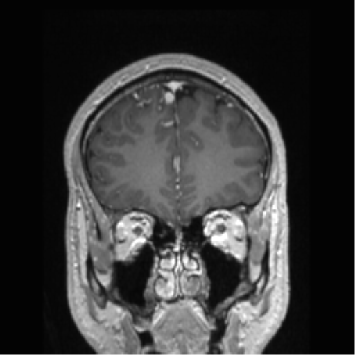 Cerebral arteriovenous malformation (Radiopaedia 39259-41506 Coronal T1 C+ 73).png