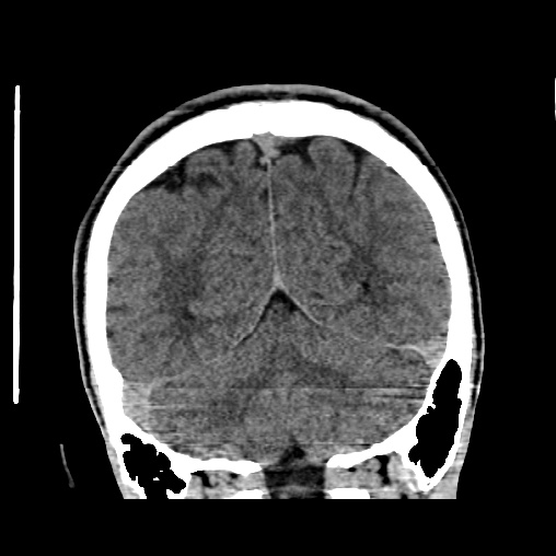 Cerebral arteriovenous malformation (Radiopaedia 61964-70028 Coronal non-contrast 46).jpg