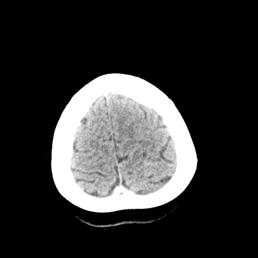 File:Cerebral arteriovenous malformation (Radiopaedia 73830-84645 Axial non-contrast 41).jpg