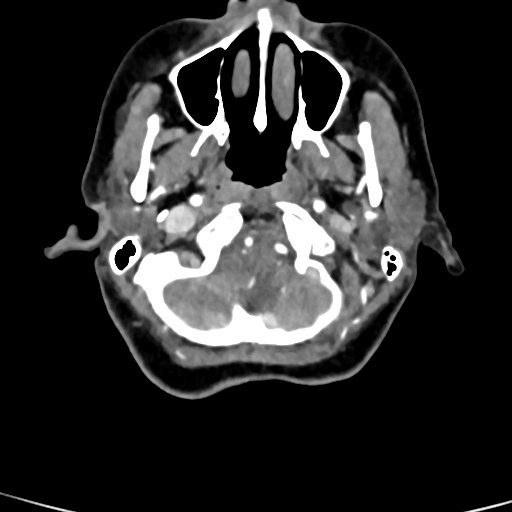 Cerebral arteriovenous malformation (Radiopaedia 73830-84645 B 91).jpg
