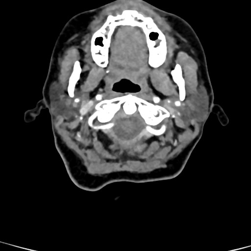 Cerebral arteriovenous malformation (Radiopaedia 73830-84645 B 97).jpg