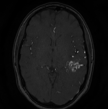 Cerebral arteriovenous malformation (Radiopaedia 74411-85654 Axial MRA 69).jpg