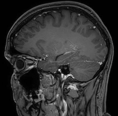 Cerebral arteriovenous malformation (Radiopaedia 74411-85654 Sagittal T1 C+ 40).jpg