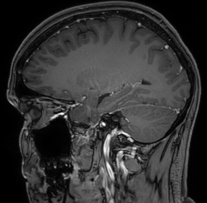 Cerebral arteriovenous malformation (Radiopaedia 74411-85654 Sagittal T1 C+ 43).jpg