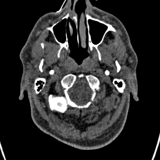 File:Cerebral arteriovenous malformation (Radiopaedia 78188-90746 Axial non-contrast 12).jpg