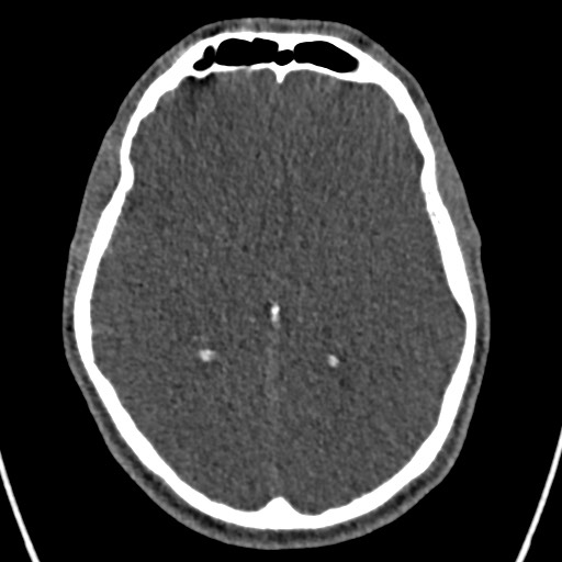 Cerebral arteriovenous malformation (Radiopaedia 78188-90746 Axial non-contrast 89).jpg