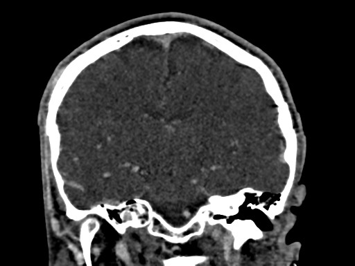Cerebral arteriovenous malformation (Radiopaedia 78188-90746 Coronal C+ delayed 63).jpg