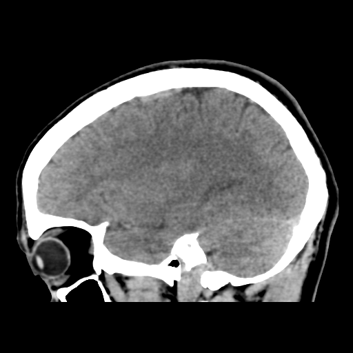 Cerebral arteriovenous malformation (Spetzler-Martin grade 2) (Radiopaedia 41262-44076 A 22).png