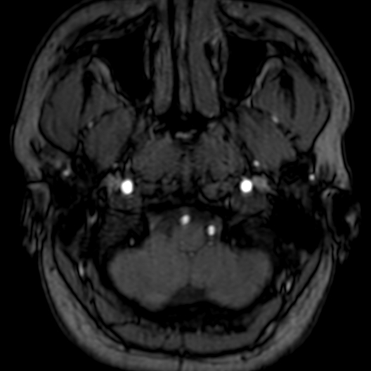 Cerebral arteriovenous malformation at posterior body of corpus callosum (Radiopaedia 74111-84925 Axial MRA 8).jpg
