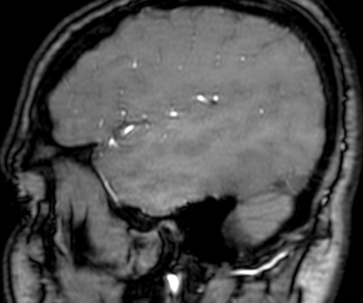Cerebral arteriovenous malformation at posterior body of corpus callosum (Radiopaedia 74111-84925 J 339).jpg