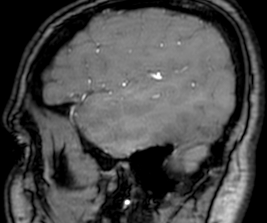 Cerebral arteriovenous malformation at posterior body of corpus callosum (Radiopaedia 74111-84925 J 347).jpg