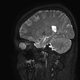 Cerebral arteriovenous malformation at posterior body of corpus callosum (Radiopaedia 74111-84925 Sagittal T2 41).jpg