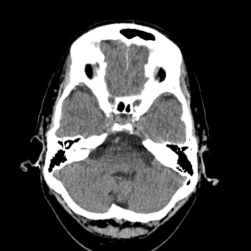 Cerebral arteriovenous malformation with lobar hemorrhage (Radiopaedia 35598-37117 Axial non-contrast 11).jpg