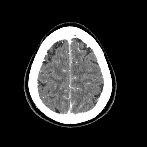 Cerebral arteriovenous malformation with lobar hemorrhage (Radiopaedia 35598-57216 A 52).jpg