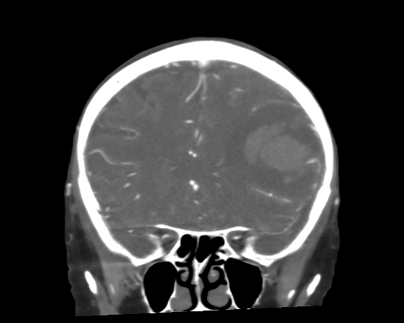 Cerebral arteriovenous malformation with lobar hemorrhage (Radiopaedia 44725-48511 A 20).png