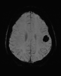 Cerebral cavernous venous malformation (Radiopaedia 70008-80021 Axial SWI 49).jpg