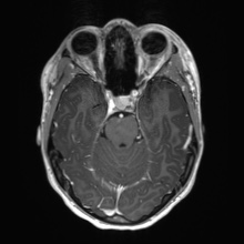 Cerebral cavernous venous malformation (Radiopaedia 70008-80021 Axial T1 C+ 23).jpg