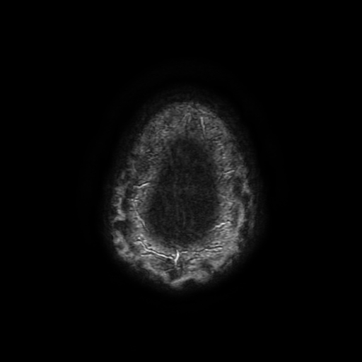 File:Cerebral cavernous venous malformation (Zabramski type II) (Radiopaedia 85511-101198 Axial SWI 115).jpg
