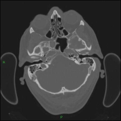 Cerebral contusions (Radiopaedia 33868-35039 Axial bone window 35).jpg