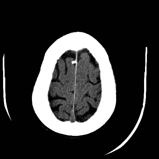 Cerebral edema (evolution in time) (Radiopaedia 19418-19440 non-contrast 82).jpg