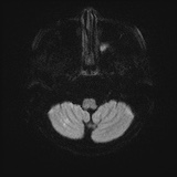 Cerebral embolic infarcts (embolic shower) (Radiopaedia 72391-82921 Axial DWI 34).jpg