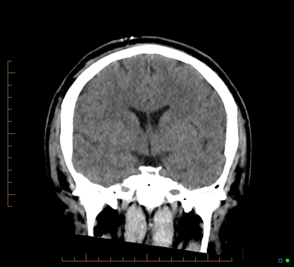 Cerebral fat embolism (Radiopaedia 85521-101224 Coronal non-contrast 30).jpg