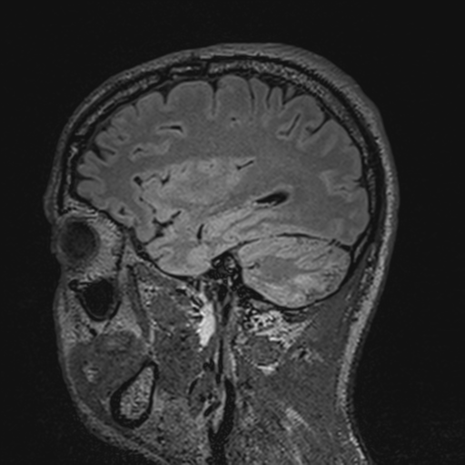 File:Cerebral hemorrhagic contusions- temporal evolution (Radiopaedia 40224-42757 Sagittal T1 25).png