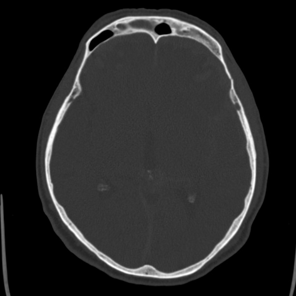 Cerebral hemorrhagic contusions (Radiopaedia 23145-23188 Axial bone window 27).jpg
