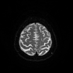 File:Cerebral metastases - melanoma (Radiopaedia 80972-94522 Axial DWI 89).jpg