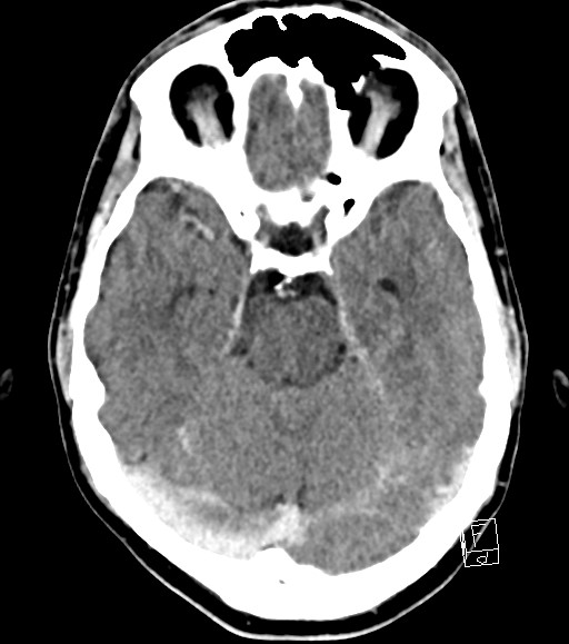 Cerebral metastases - testicular choriocarcinoma (Radiopaedia 84486-99855 Axial C+ delayed 37).jpg