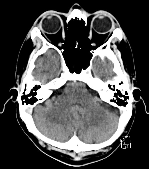 Cerebral metastases - testicular choriocarcinoma (Radiopaedia 84486-99855 Axial C+ delayed 42).jpg