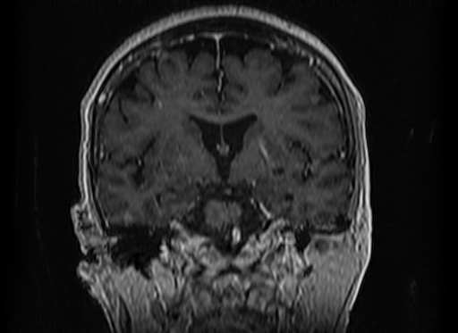 Cerebral metastases from lung cancer with amyloid angiopathy and cerebellopontine angle meningioma (Radiopaedia 74306-85191 Coronal T1 C+ 28).jpg