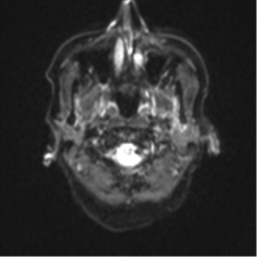 Cerebral metastasis (Radiopaedia 46744-51248 Axial DWI 1).png