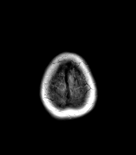 File:Cerebral metastasis (Radiopaedia 46744-51248 Axial FLAIR 27).png