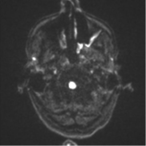 Cerebral metastasis - melanoma (Radiopaedia 54718-60954 Axial DWI 33).png