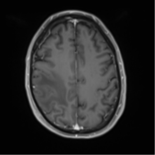 Cerebral metastasis - melanoma (Radiopaedia 54718-60954 Axial T1 C+ fat sat 39).png