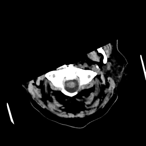 File:Cerebral metastasis to basal ganglia (Radiopaedia 81568-95412 Axial non-contrast 8).png