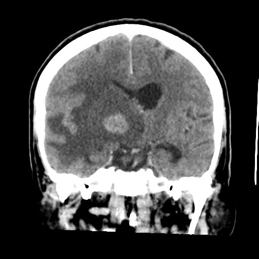 Cerebral metastasis to basal ganglia (Radiopaedia 81568-95412 Coronal C+ delayed 32).png