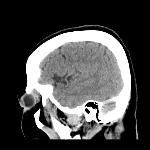 File:Cerebral metastasis to basal ganglia (Radiopaedia 81568-95412 Sagittal C+ delayed 45).png