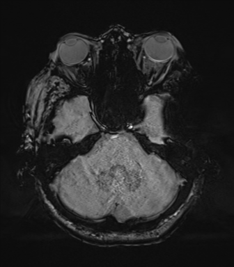 Cerebral metastasis to basal ganglia (Radiopaedia 81568-95413 Axial SWI 20).png