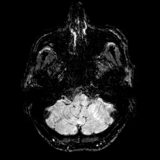 Cerebral parenchymal arteriovenous malformation (Radiopaedia 27280-27456 Axial SWI 6).jpg