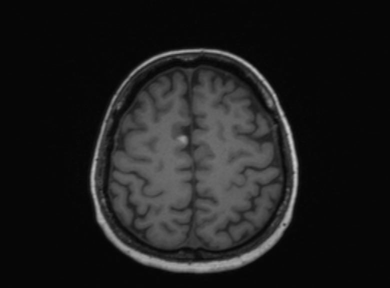 Cerebral ring enhancing lesions - cerebral metastases (Radiopaedia 44922-48817 Axial T1 153).jpg