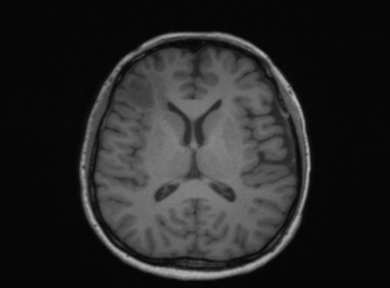 Cerebral ring enhancing lesions - cerebral metastases (Radiopaedia 44922-48817 Axial T1 212).jpg