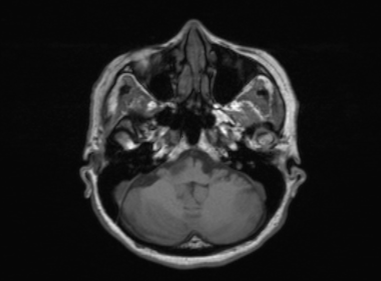 Cerebral ring enhancing lesions - cerebral metastases (Radiopaedia 44922-48817 Axial T1 310).jpg