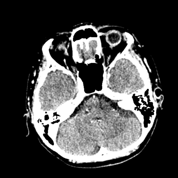Cerebral ring enhancing lesions - cerebral metastases (Radiopaedia 44922-48818 B 82).jpg