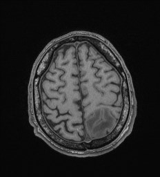 Cerebral toxoplasmosis (Radiopaedia 43956-47461 Axial T1 65).jpg