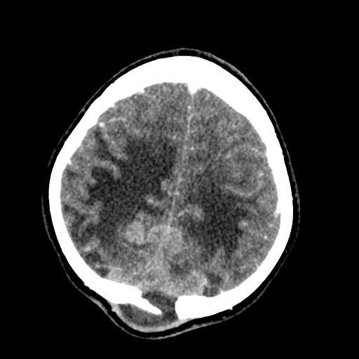 Cerebral tuberculosis with dural sinus invasion (Radiopaedia 60353-68019 Axial C+ delayed 53).jpg