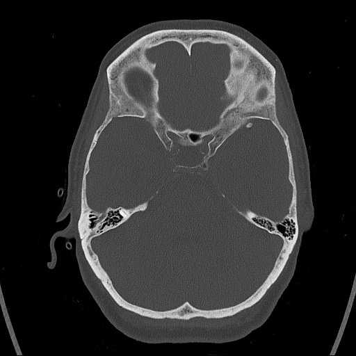 Cerebral venous infarction with hemorrhage (Radiopaedia 65343-74381 Axial bone window 42).jpg