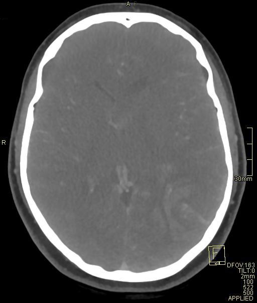 Cerebral venous sinus thrombosis (Radiopaedia 91329-108965 Axial venogram 43).jpg